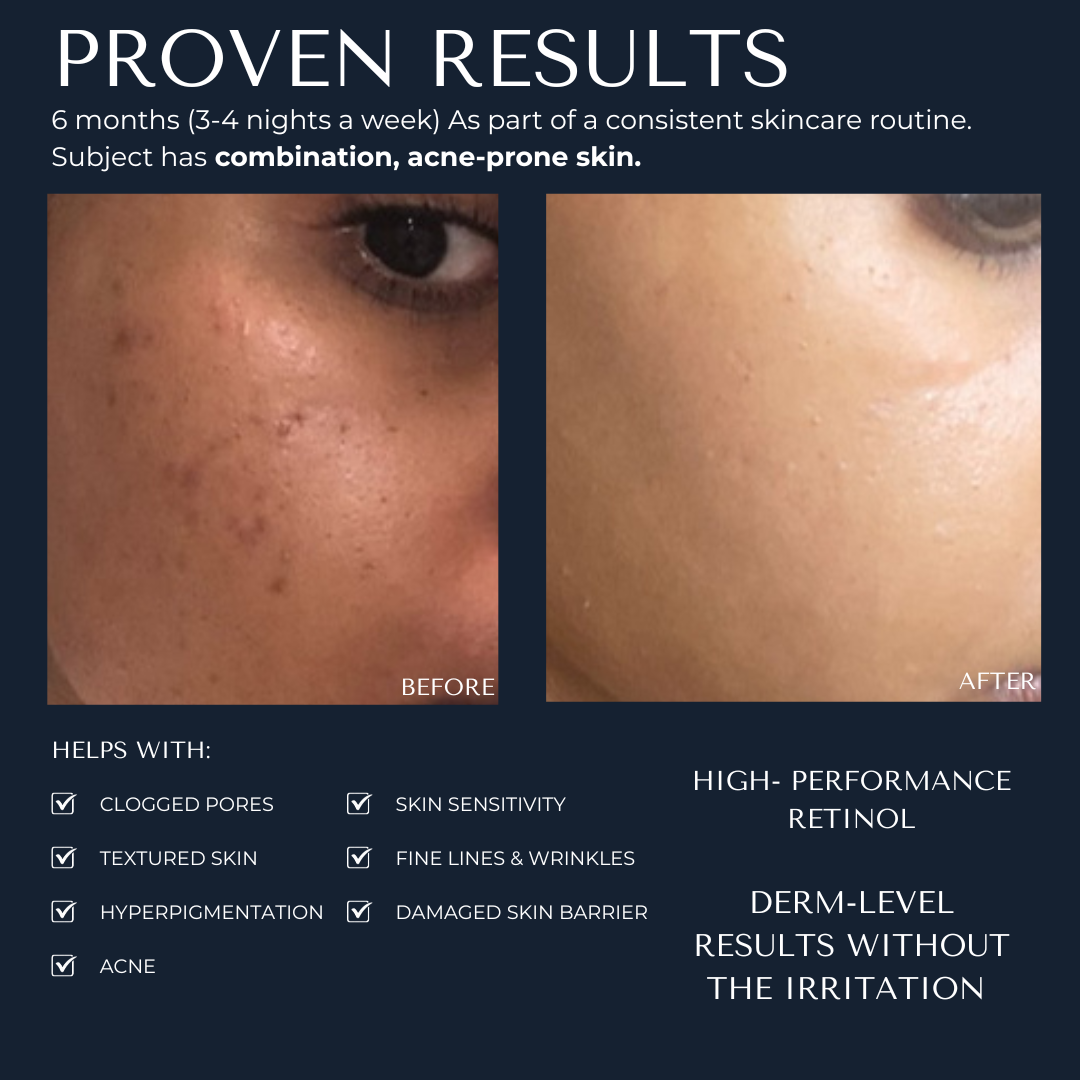 1% Retinol Night Treatment