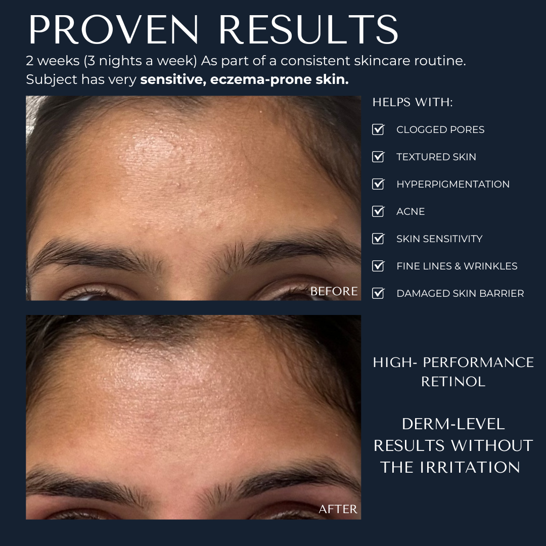 1% Retinol Night Treatment