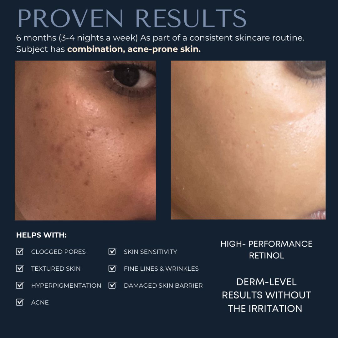 1% Retinol Night Treatment